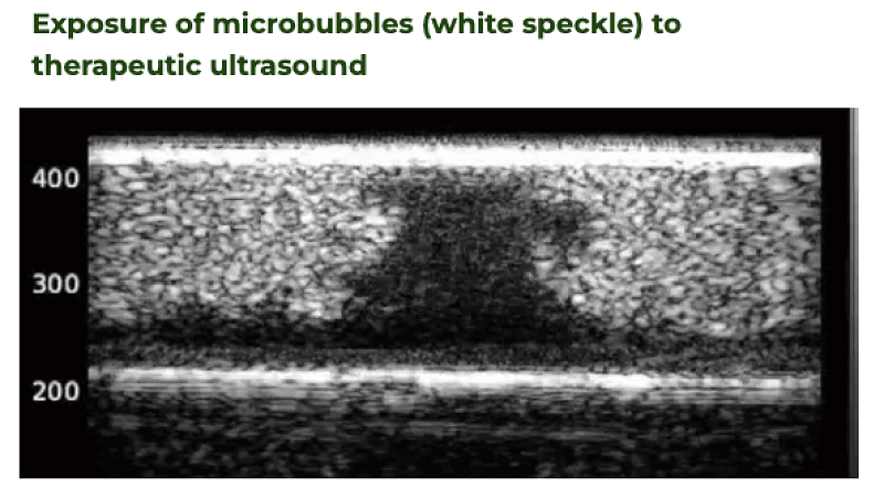 Exposure of microbubbles (white speckle) to therapeutic ultrasound